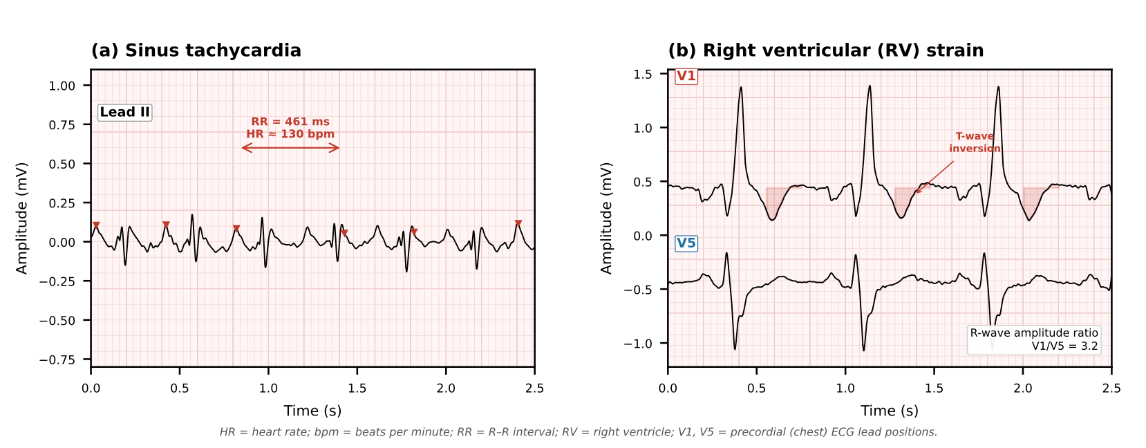 TriCardio ECG Sample